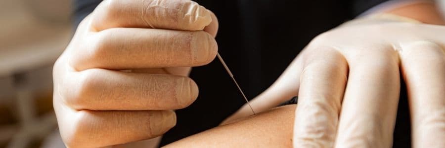 Dry Needling at Anatomy Rehab