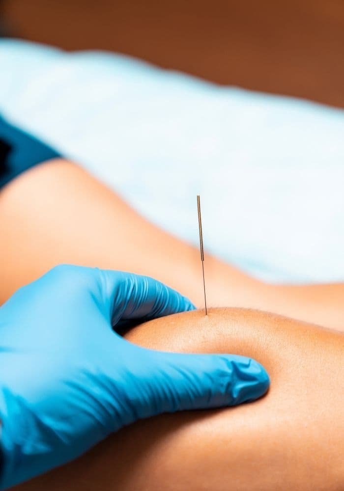 Dry Needling