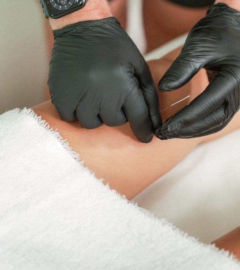 Dry Needling